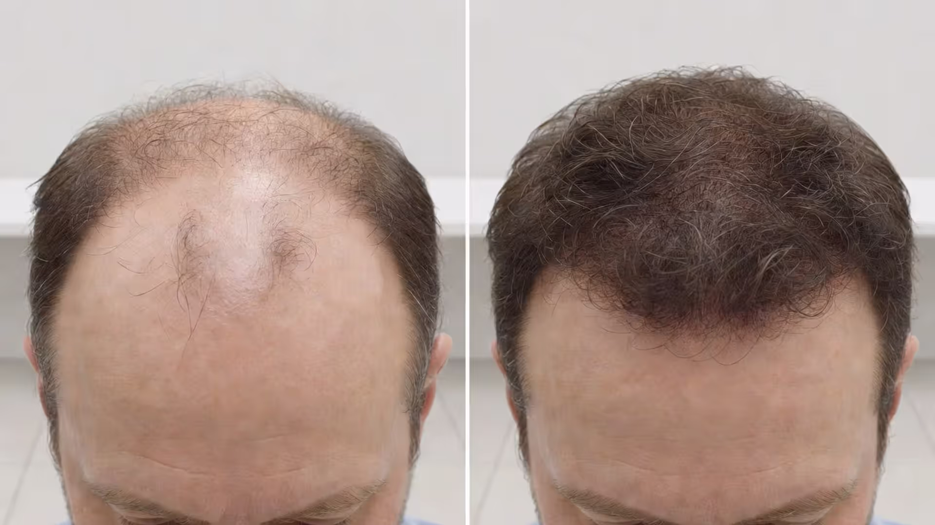 How Long Does a Hair Transplant Last and What to Expect