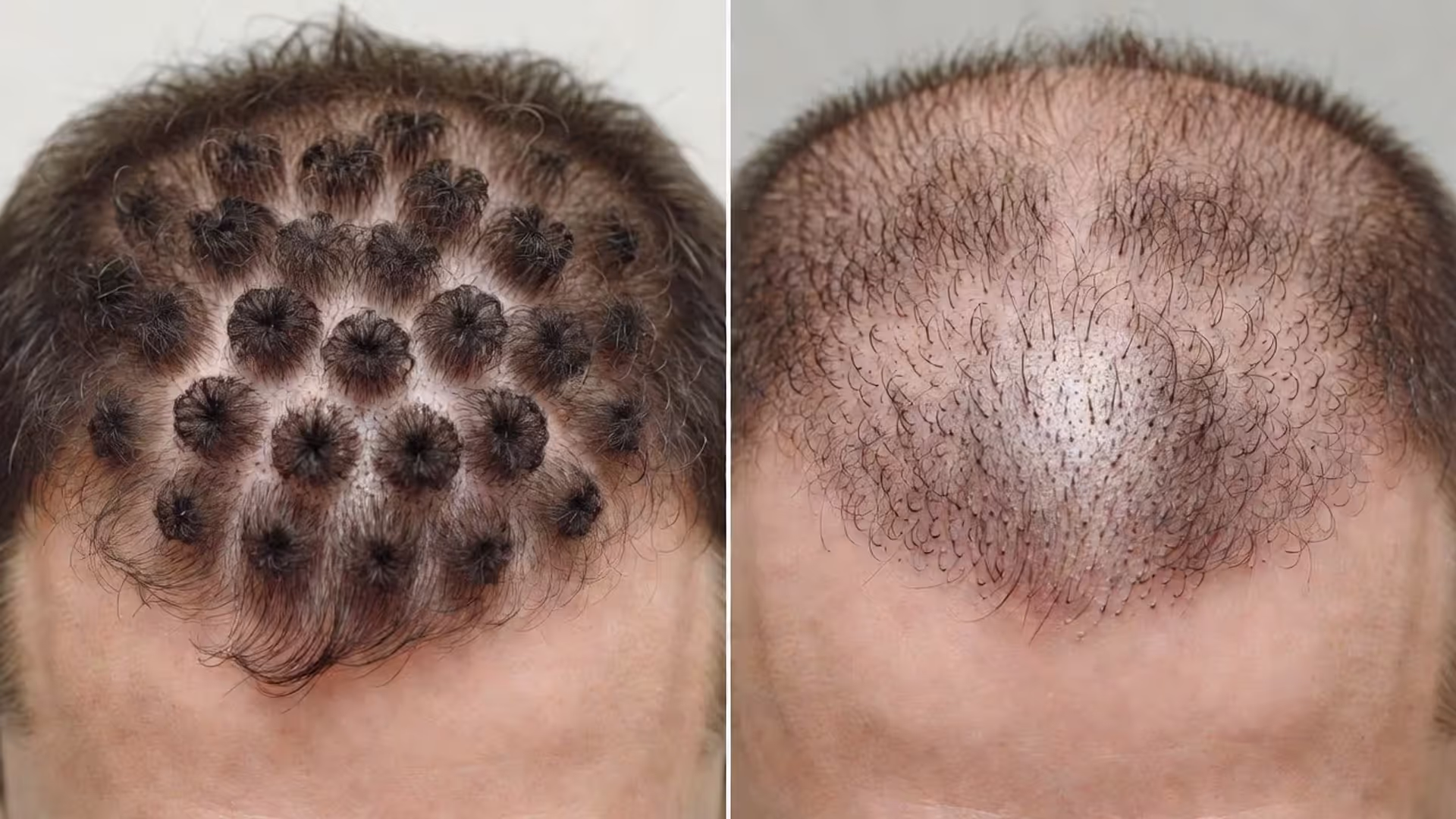 What Are Hair Plugs and How Do They Work