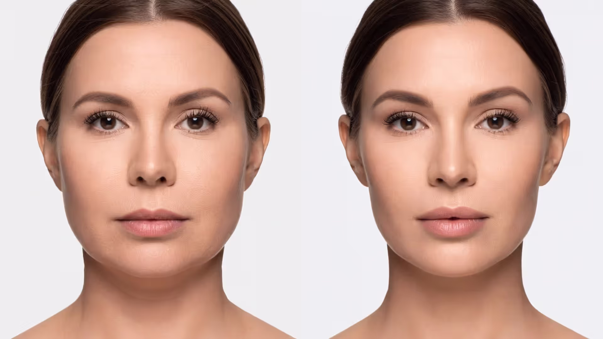 Masseter Botox Before and After What to Realistically Expect